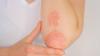 Sedef (Psoriasis)
